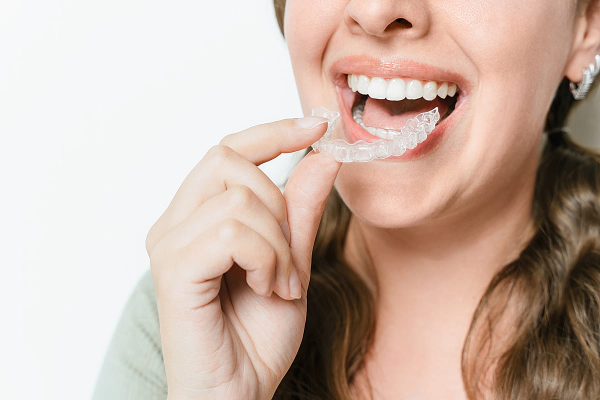 “Close-up of a person smiling while placing a clear Invisalign aligner onto their teeth.