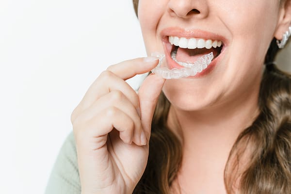 “Close-up of a person smiling while placing a clear Invisalign aligner onto their teeth.